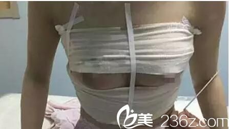 术后第四天隆胸恢复 术后第四天隆胸恢复