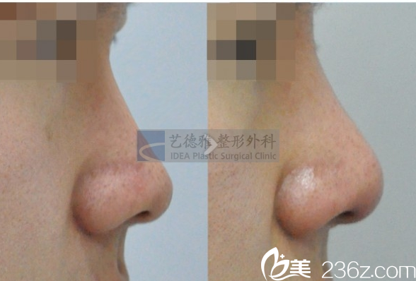 韩国艺德雅整形外科案例 韩国艺德雅整形外科案例