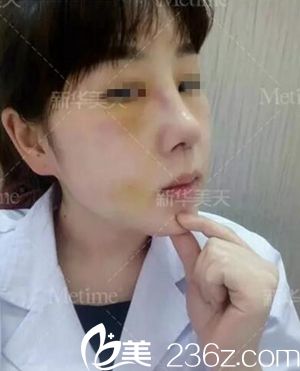 在大连新华美天做隆鼻手术后4天.jpg