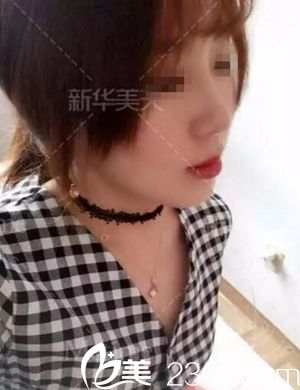 在大连新华美天做隆鼻手术后1个月.jpg