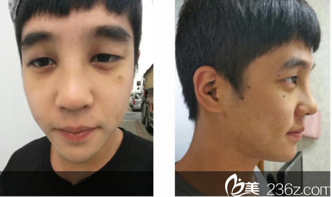 术后和术前的对比图