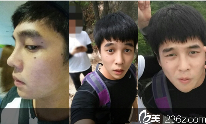 手术前后对比图