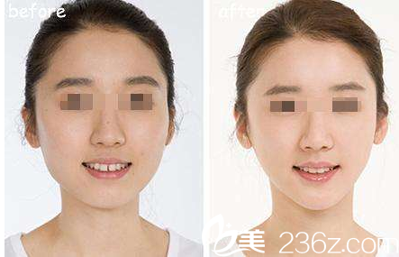 韩国在敦整形外科案例 韩国在敦整形外科案例