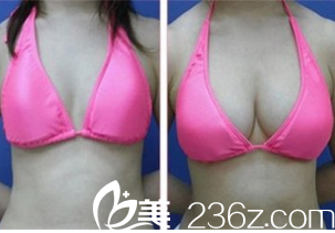 韩国在敦整形外科案例 韩国在敦整形外科案例