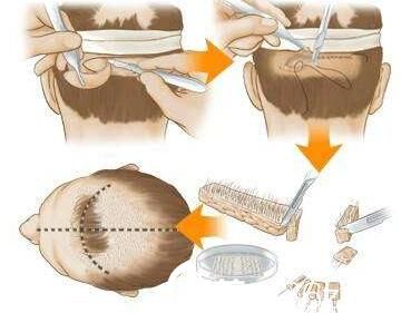 韩国iWell爱我整形外科医院毛发移植