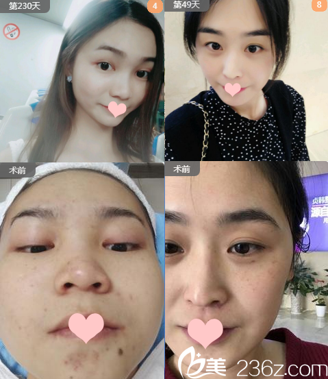 南宁贞韩医疗美容门诊部郝帅美肤案例 南宁贞韩医疗美容门诊部郝帅美肤案例