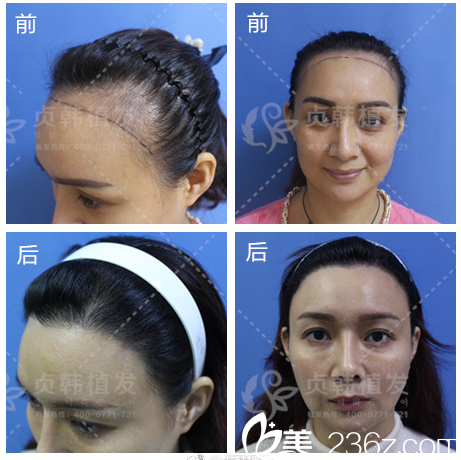 南宁贞韩整形医院郝帅植发案例 南宁贞韩整形医院郝帅植发案例