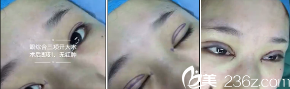 亳州缔美李士成眼综合术前术后对比图 亳州缔美李士成眼综合术前术后对比图