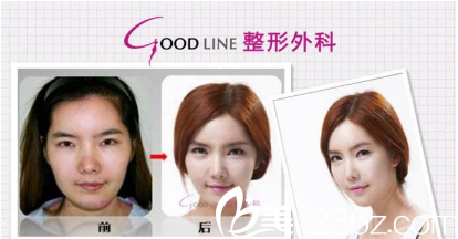韩国GOOD-LINE崔德浩整形外科案例