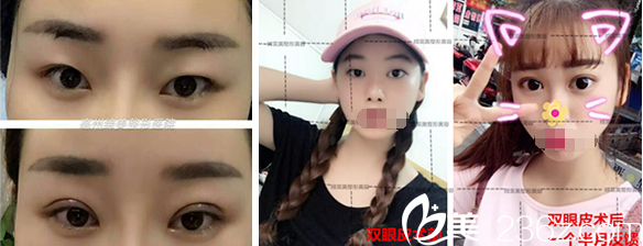 亳州缔美李士成双眼皮整形案例 亳州缔美李士成双眼皮整形案例