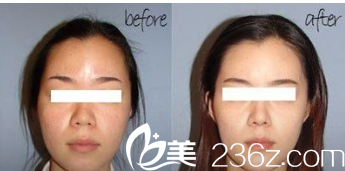 韩国GOOD LINE崔德浩整形外科案例 韩国GOOD LINE崔德浩整形外科案例