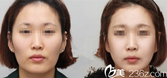 韩国GOOD LINE崔德浩整形外科案例 韩国GOOD LINE崔德浩整形外科案例