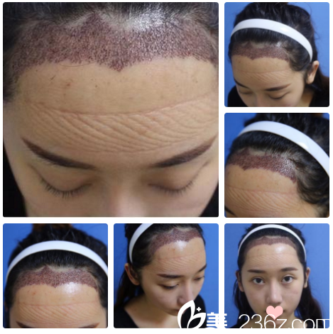 南宁贞韩发际线种植第二天自拍