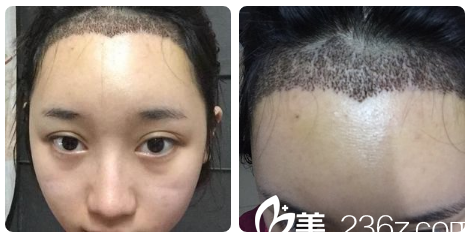 在南宁贞韩做发际线种植5天结痂图