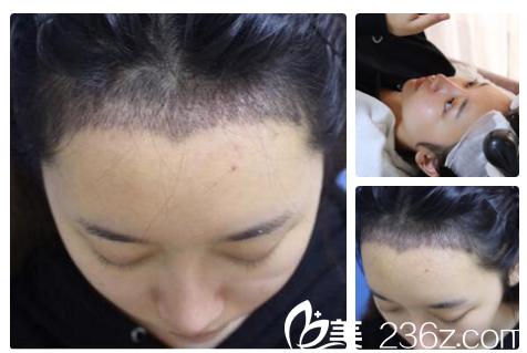 发际线种植10天清洗痂皮后的样子