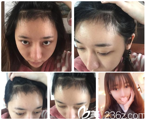 南宁贞韩发际线种植2个月效果