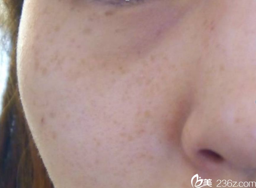 雀斑、黄褐斑治疗案例 韩国童颜中心 雀斑、黄褐斑治疗案例 韩国童颜中心