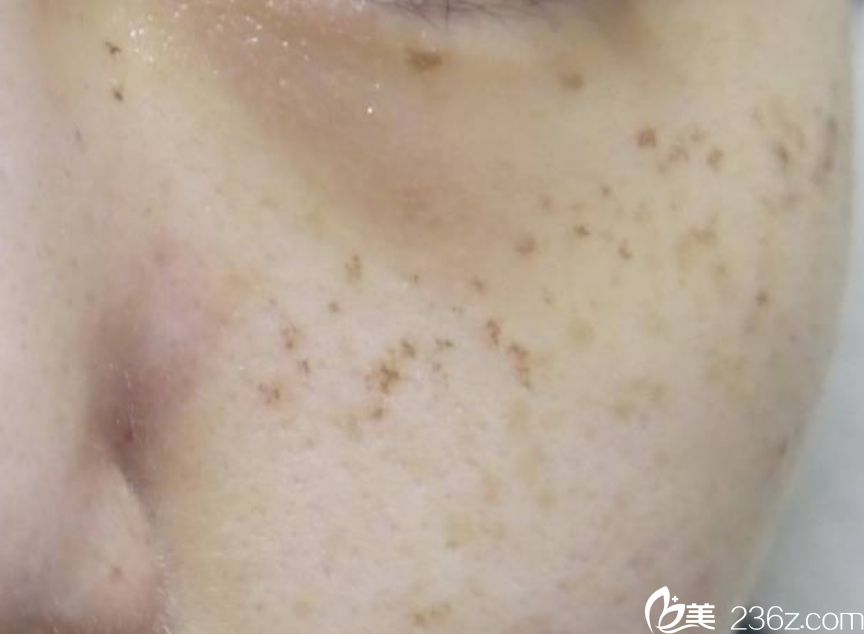 韩国童颜中心祛斑效果好吗 韩国童颜中心祛斑效果好吗