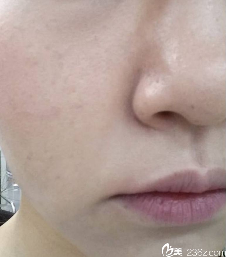 韩国童颜中心祛斑真人案例对比图 韩国童颜中心祛斑真人案例对比图