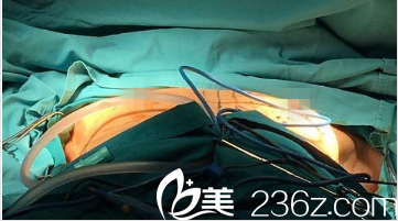 韩国GOOD LINE崔德浩整形外科案例 韩国GOOD LINE崔德浩整形外科案例