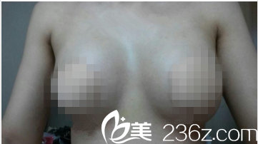 韩国GOOD LINE崔德浩整形外科案例 韩国GOOD LINE崔德浩整形外科案例