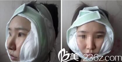  韩国iWell爱我整形外科真人案例术后天