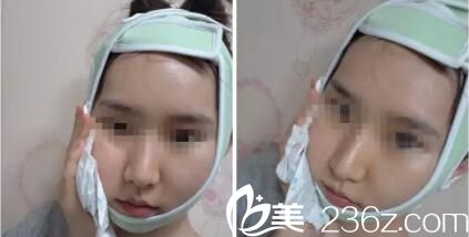  韩国iWell爱我整形外科真人案例术后第五天