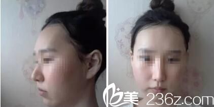  韩国iWell爱我整形外科真人案例术后14天