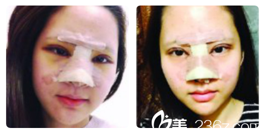 深圳美莱梁志为双眼皮+隆鼻第4天效果 深圳美莱梁志为双眼皮+隆鼻第4天效果