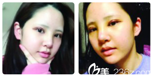 找梁志为做完眼睛鼻子半个月自拍 找梁志为做完眼睛鼻子半个月自拍