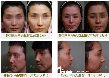 韩国O&YOUNG整形外科案例 韩国O&YOUNG整形外科案例