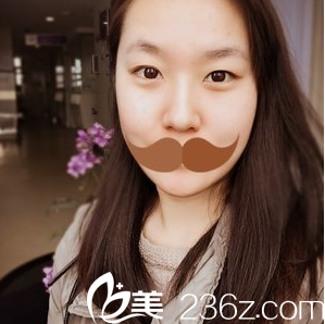 闫品行切开双眼皮+开内眼角术术前照 闫品行切开双眼皮+开内眼角术术前照