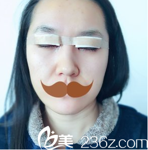 安徽韩美整形闫品行切开双眼皮术后1天 安徽韩美整形闫品行切开双眼皮术后1天