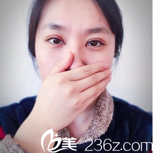 安徽韩美切开双眼皮+开内眼角术后2天效果 安徽韩美切开双眼皮+开内眼角术后2天效果