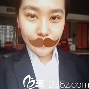 安徽韩美整形双眼皮手术第四天恢复情况 安徽韩美整形双眼皮手术第四天恢复情况