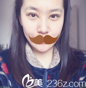 闫品行切开双眼皮术后3天恢复情况 闫品行切开双眼皮术后3天恢复情况