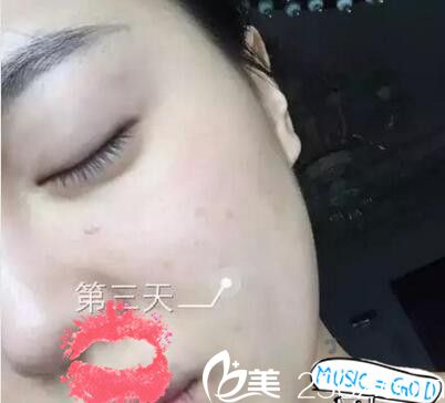 南阳艾美水光注射第三天 南阳艾美水光注射第三天