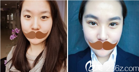 闫品行切开双眼皮术前术后对比 闫品行切开双眼皮术前术后对比