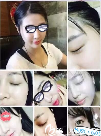 南阳艾美水光注射第七天 南阳艾美水光注射第七天