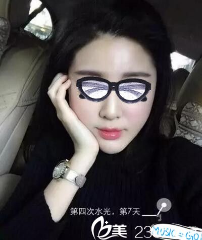 在南阳艾美做了水光注射还一个水嫩嫩的自己