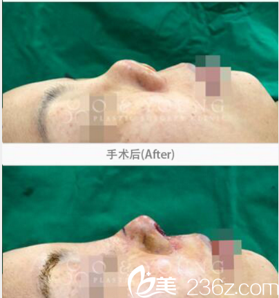 韩国O&YOUNG整形外科案例 韩国O&YOUNG整形外科案例