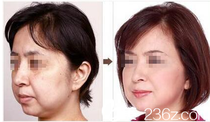 韩国O&YOUNG整形外科案例 韩国O&YOUNG整形外科案例