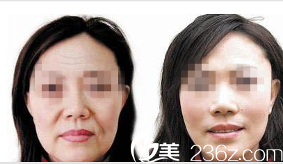 韩国O&YOUNG整形外科案例 韩国O&YOUNG整形外科案例