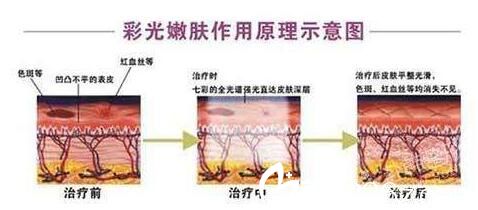 韩国奥拉克皮肤科整外科彩光嫩肤图 韩国奥拉克皮肤科整外科彩光嫩肤图