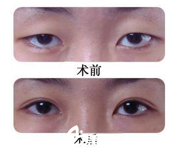 韩国O&YOUNG整形外科案例