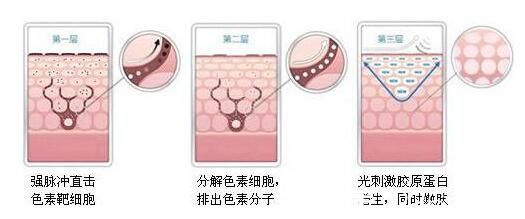 韩国奥拉克皮肤科整外科激光美白图 韩国奥拉克皮肤科整外科激光美白图