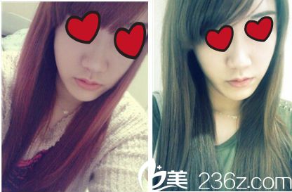 鼻整形+脂肪移植手术对比 鼻整形+脂肪移植手术对比