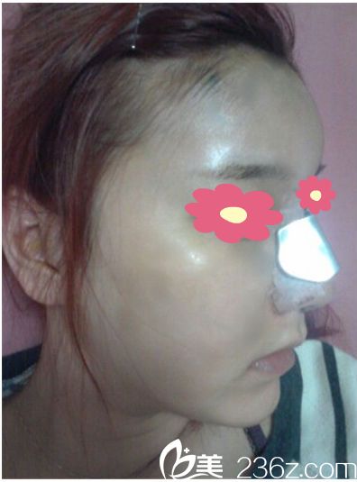 鼻整形+脂肪移植手术两天 鼻整形+脂肪移植手术两天