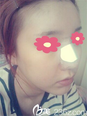 鼻整形+脂肪移植手术三天 鼻整形+脂肪移植手术三天