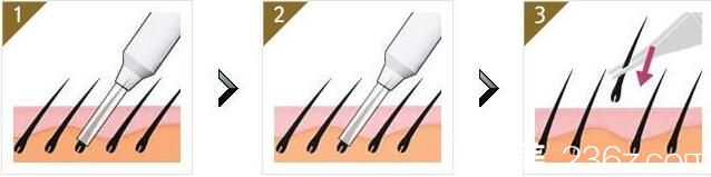 韩国奥拉克皮肤科整外科毛发移植 韩国奥拉克皮肤科整外科毛发移植